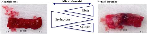 white thrombus blood tube